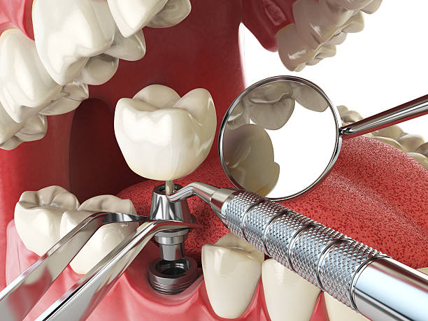 Best Broken or Chipped Tooth Repair in Jericho, NY
